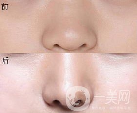 鼻翼縮小圖 鼻翼縮小有什么后遺癥嗎？
