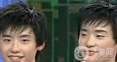 李鐘碩承認整容：李鐘碩整容前后照片