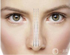 *扁平鼻成形術(shù)的特點(diǎn)和操作方法