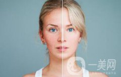 光子嫩膚多久做一次比較好？