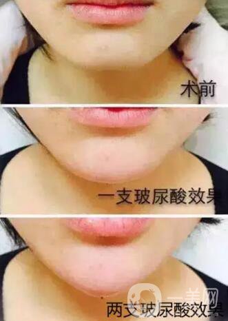 玻尿酸豐下巴需要幾針？兩針玻尿酸下巴*果圖