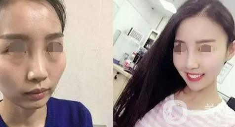 磨顴骨照片 磨顴骨*果怎么樣？