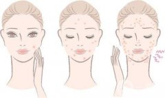 痤瘡調(diào)節(jié)方案 產(chǎn)生痤瘡的原因