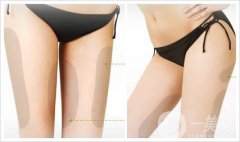 大腿抽脂需要多久恢復正常呢