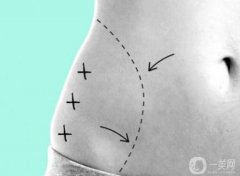 360度環(huán)形吸脂10斤照片曝光，果雖好……