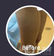 腿部環(huán)形抽脂果如何？小粗腿到筷子腿就這么簡單