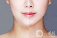 下巴抽脂有什么風(fēng)險？醫(yī)生說副作用有這些