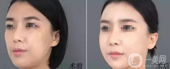 自體脂肪填下巴優(yōu)缺點介紹