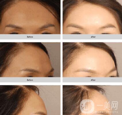 自體脂肪填充額頭多久恢復(fù)自然 整形專家這樣說(shuō)