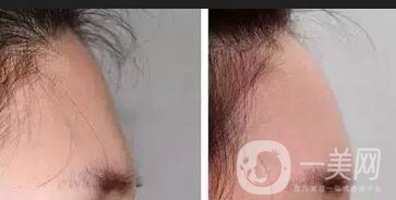 脂肪填充額頭