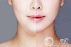 雙下巴抽脂多久恢復(fù)？雙下巴抽脂七天后能相親嗎