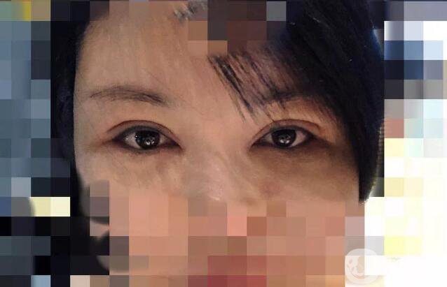 處楊曉楠雙眼皮案例 楊曉楠醫(yī)生怎么樣？