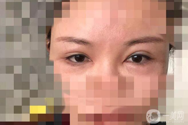 處楊曉楠雙眼皮案例 楊曉楠醫(yī)生怎么樣？