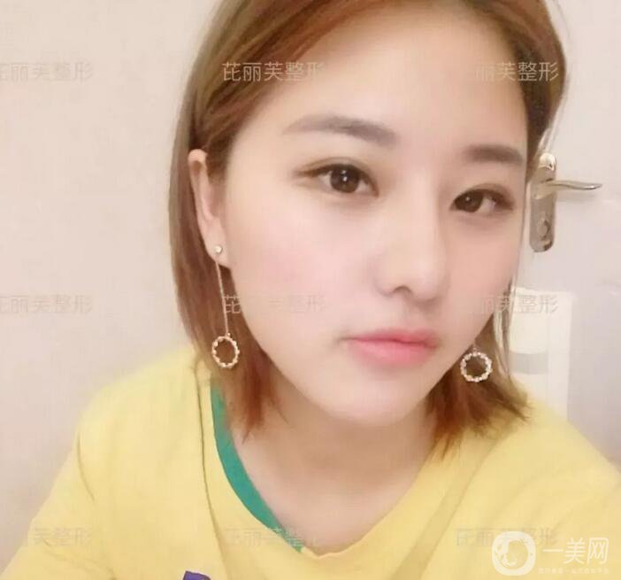 面部光纖溶脂