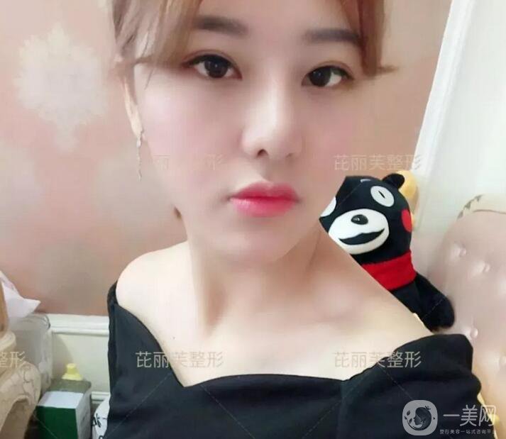 面部光纖溶脂