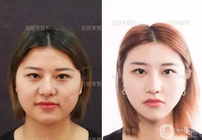 面部光纖溶脂