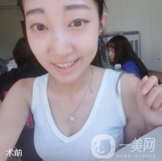 脂肪隆胸手術真實經歷：過來人說說從A到C的改變