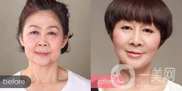 *對(duì)魚尾紋的作用：注射部位和副作用