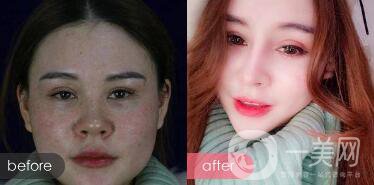 注射隆鼻整形多少要錢？微整形注射隆鼻過程