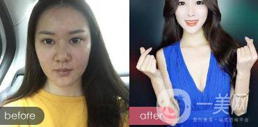 注射隆鼻整形多少要錢？微整形注射隆鼻過程