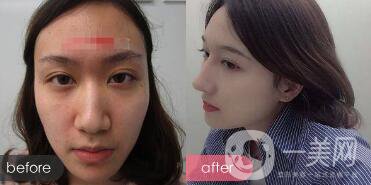 歪鼻整形痛嗎？歪鼻矯正圖片