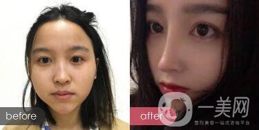 歪鼻整形痛嗎？歪鼻矯正圖片