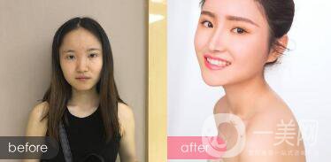 歪鼻整形痛嗎？歪鼻矯正圖片