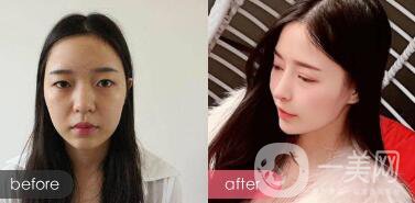 成都綜合隆鼻多少錢？綜合隆鼻真人案例