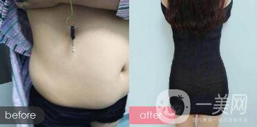 成都抽脂減肥價(jià)格多少?成都抽全身脂要多少錢(qián)?