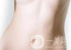 腹壁整形手術(shù)需要多少錢？
