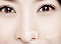 駝峰鼻整容：關于矯正駝峰鼻的方法和注意事項