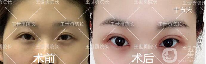 北京雙眼皮修復(fù)