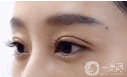 北京雙眼皮價(jià)格是多少
