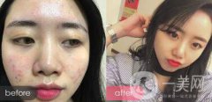 果酸祛痘*果嗎 果酸祛痘有什么好處？