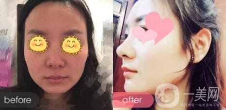 墊下巴前后