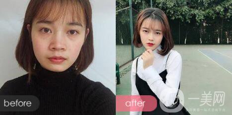 墊下巴前后