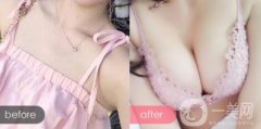 自體脂肪隆胸術(shù)前術(shù)后注意事項