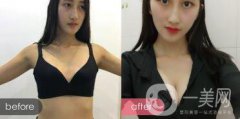 我適合做隆胸嗎 假體會放在什么位置 手術(shù)風(fēng)險(xiǎn)大不大？