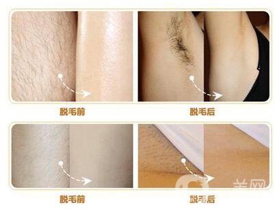 什么是激光脫毛？激光脫毛的優(yōu)勢有哪些？