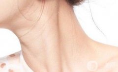 怎么消除頸紋?玻尿酸去頸紋能維持多久?