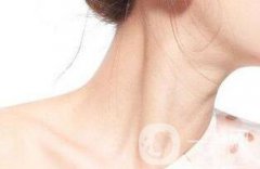 頸紋該怎么消除?去頸紋原理和果介紹