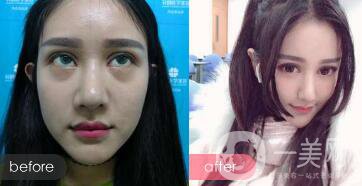 眼皮腫有眼袋