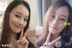 成都鼻翼縮窄多少錢？鼻翼縮小照