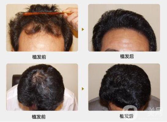 什么是植發(fā)手術(shù)？脫發(fā)的主要原因？