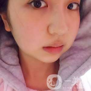 去頰脂墊瘦臉