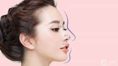 成都鼻翼縮小費用是多少呢 看成都專家怎么解析