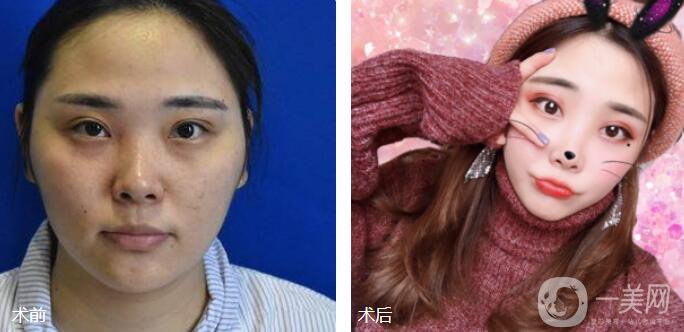磨顴骨前后照片分享介紹 真人案例 33天就看見(jiàn)*果！