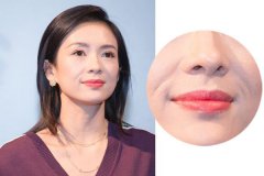 去法令紋多少錢 一針玻尿酸輕松搞定