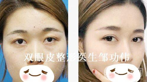 鄒功偉案例