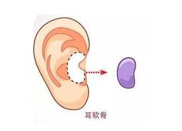 耳軟骨